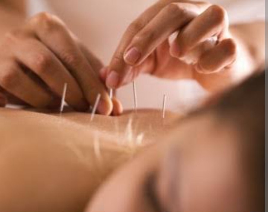 Acupuntura e Eletroacupuntura