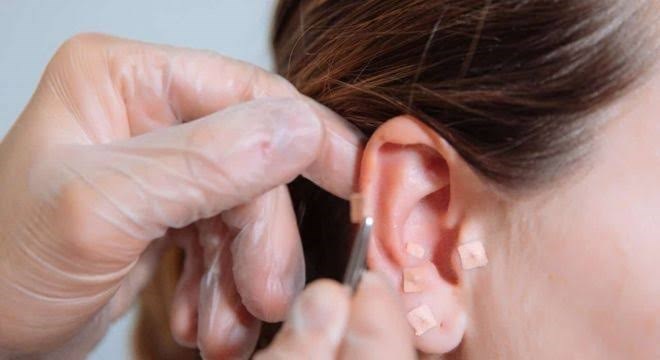Auriculoterapia ( 5 sessões)