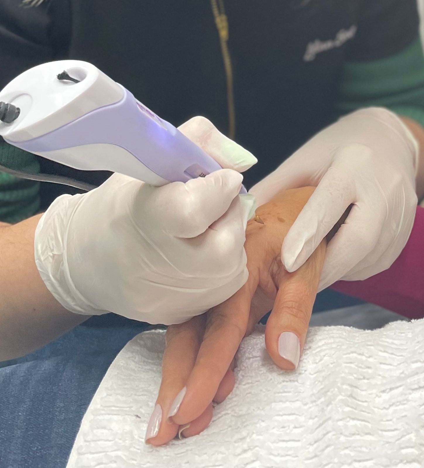 Curso Presencial Expert em Jato Plasma/ Eletrocautério 