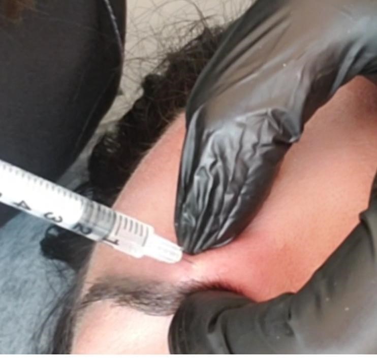 Aplicação de Toxina Botulínica em terço superior 