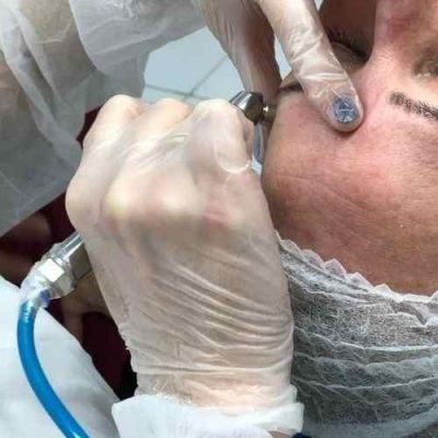 Curso Presencial Expert em Limpeza de Pele