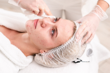 Tratamento Acne 