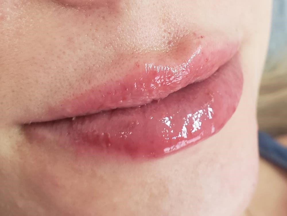 Preenchimento Labial com Ácido Hialurônico
